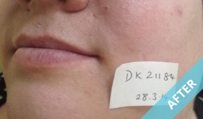 chin_a_2