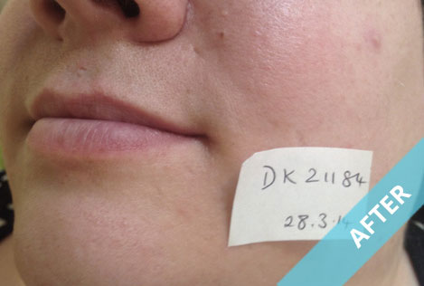 chin_a_2